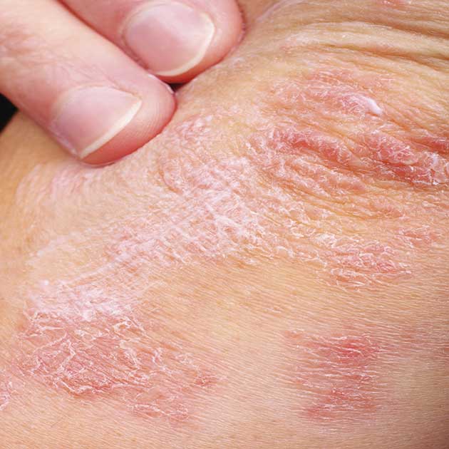 scaly skin patches