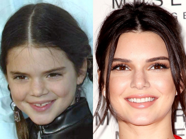 The Most Dazzling Celebrity Teeth Transformations Look