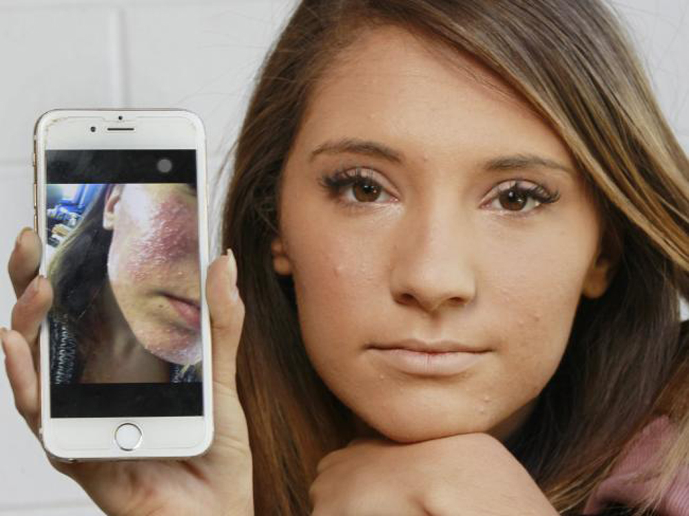 This Beauty Treatment Caused A Horrific Bacterial Skin Infection