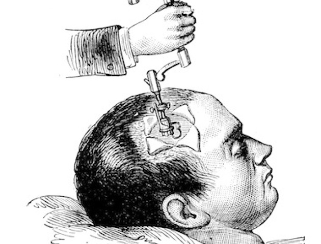 Trepanning: illustration of hole being drilled into head