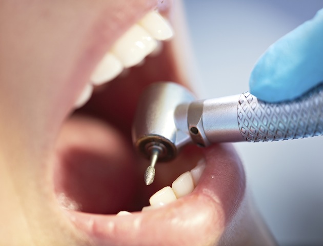 Dentist: the drill