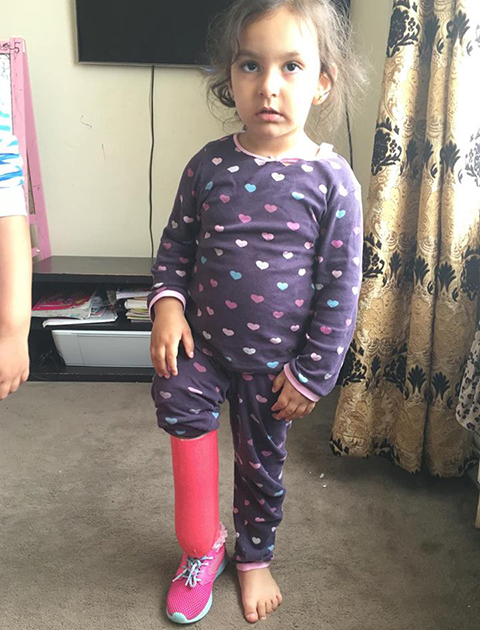 girl with proximal femoral focal deficiency