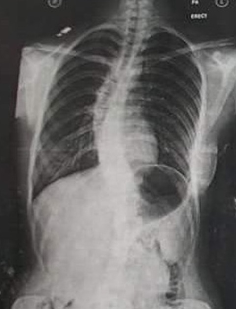 Daniella's spine before the surgery (Photo: Talk To The Press)