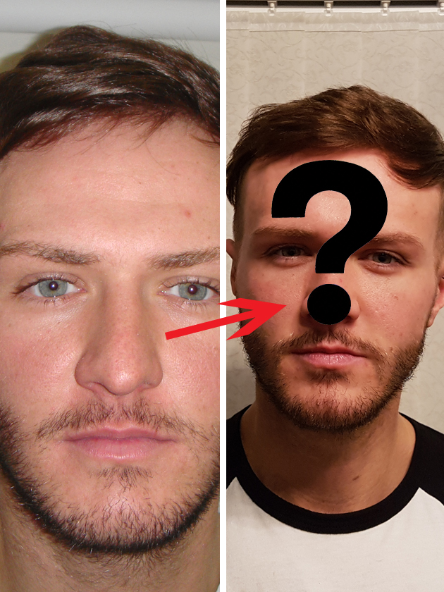 PICTURES Kyle Christie Shows Off His Nose Job But You Won t Believe How Much He Paid 