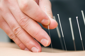 Acupuncture, fertility