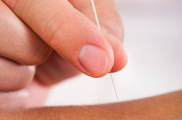 Acupuncture