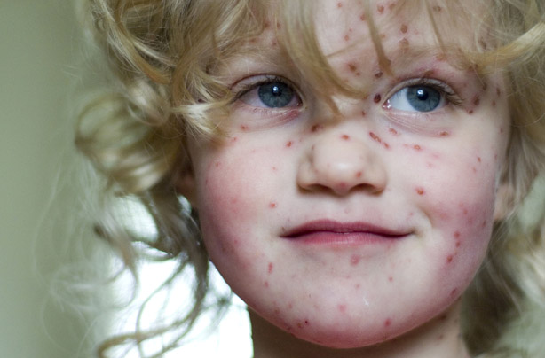 Chickenpox