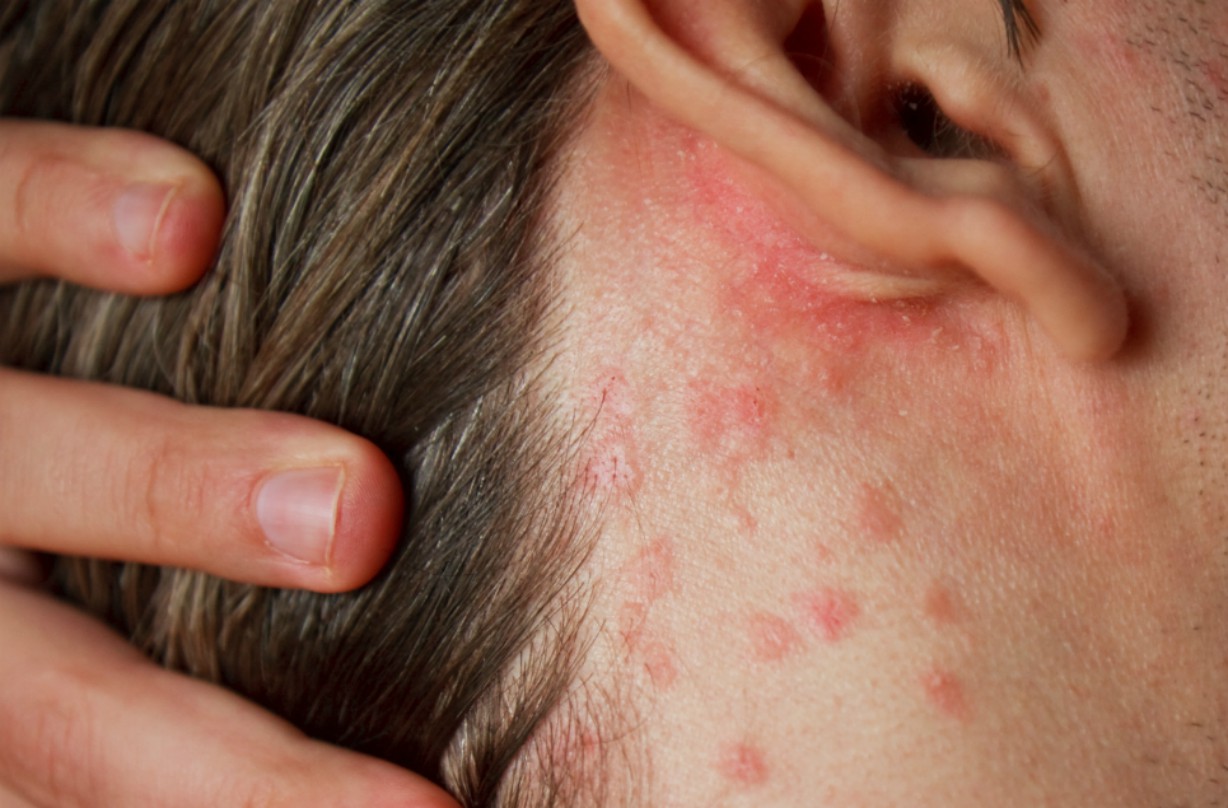 Psoriasis