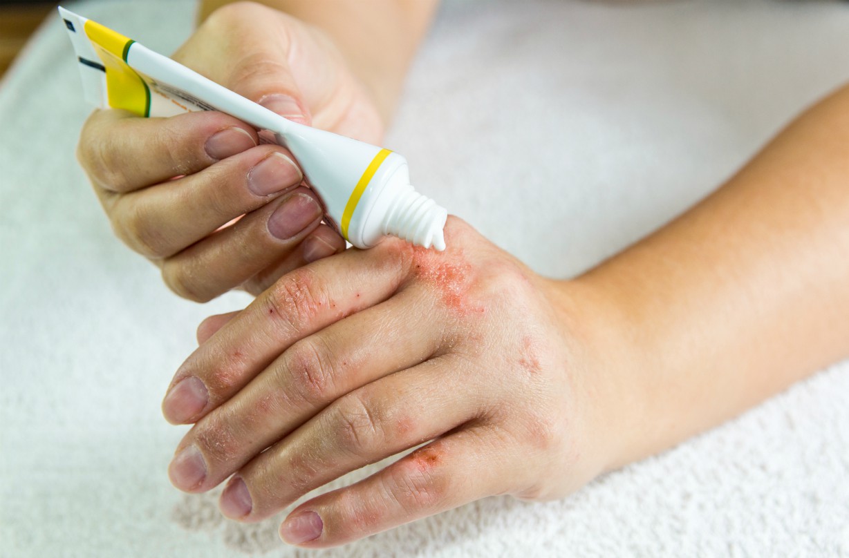 What is psoriasis?