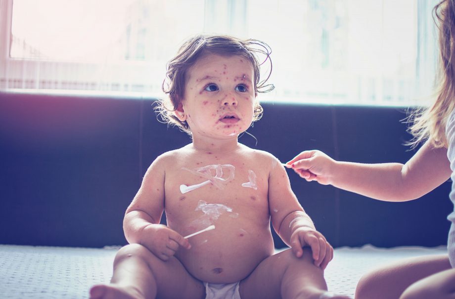 measles in children