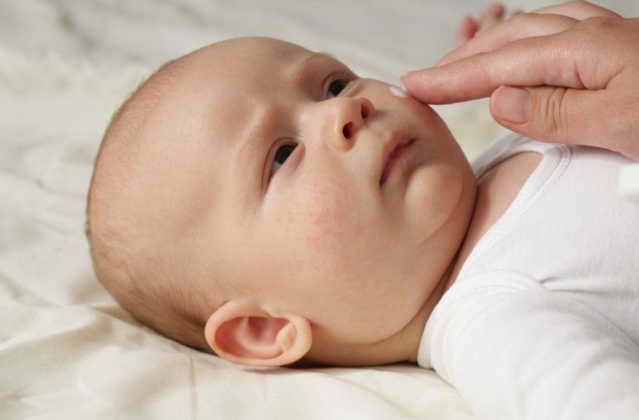 baby eczema