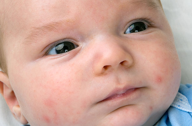 Baby Rash A Visual Guide To Skin Rashes In Babies And Children