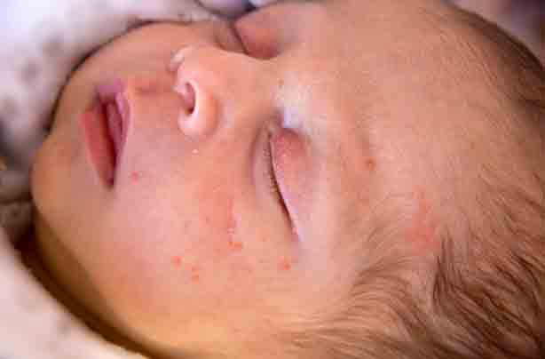 milk spots what are