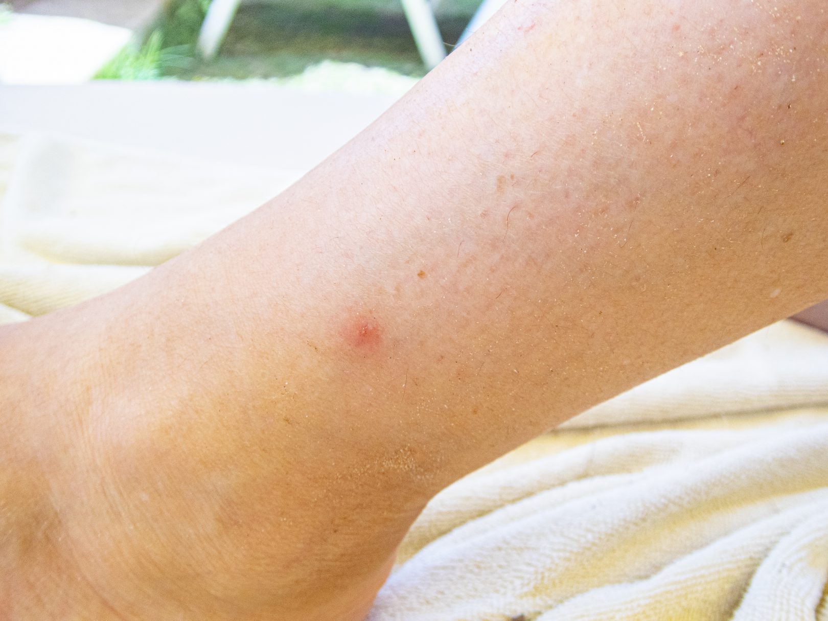 Insect bites treatment How to treat insect bites in children and adults