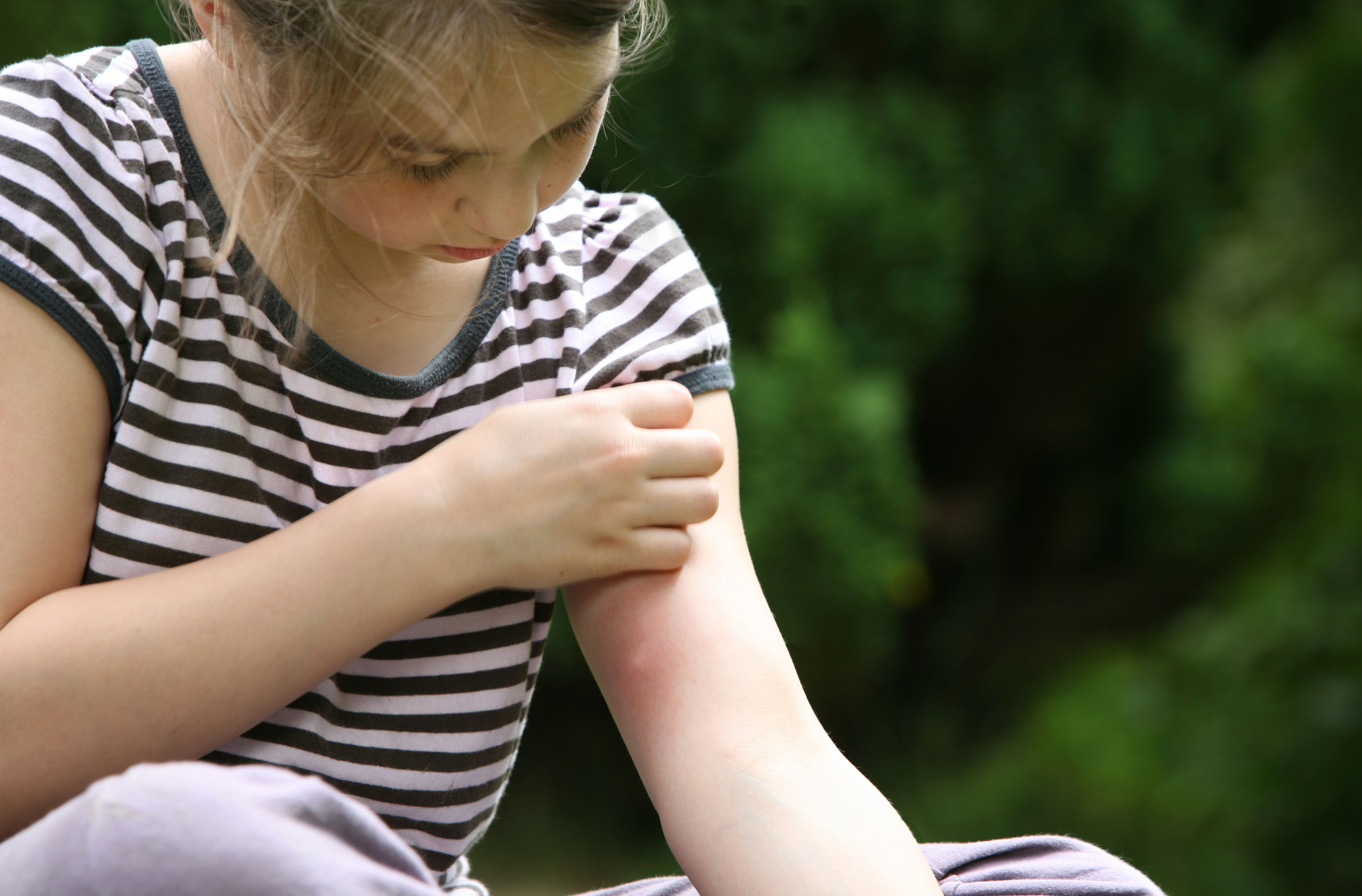 Insect bites treatment How to treat insect bites in children and adults