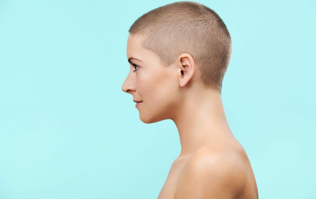 alopecia causes