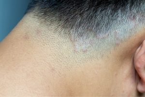 What is ringworm