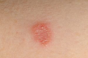 What is ringworm?