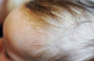 What is ringworm