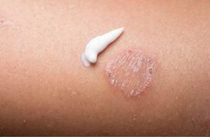 What is ringworm