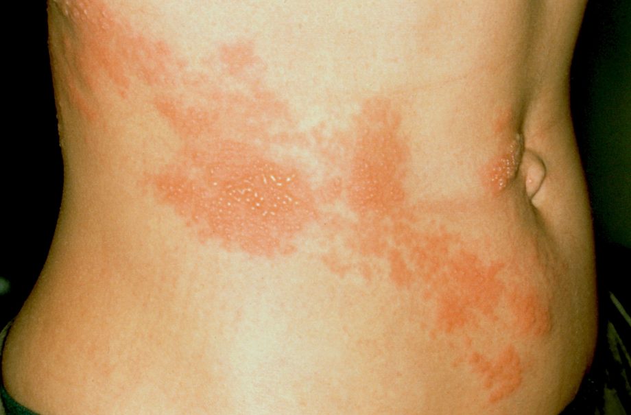 shingles
