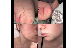 amazon acne lotion