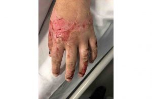 mum third degree burns hot water bottle explodes