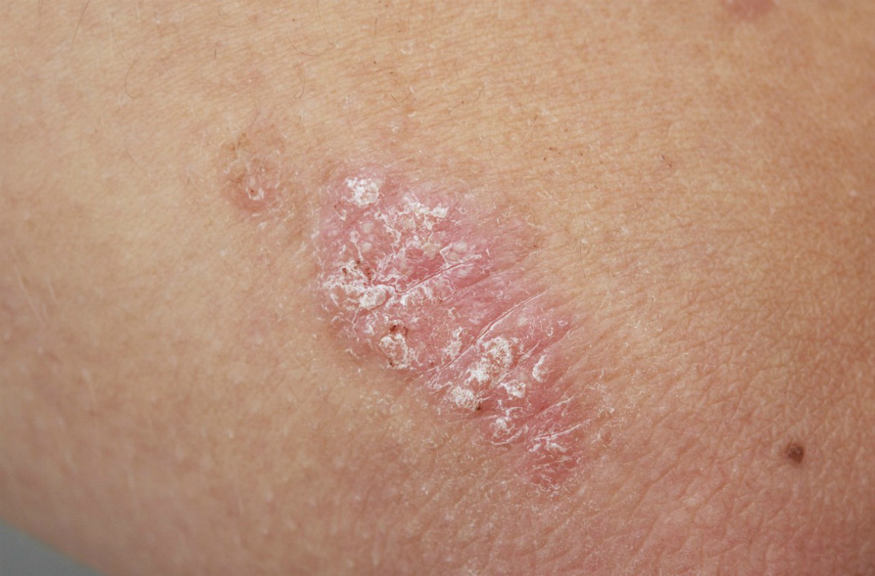 What is psoriasis?