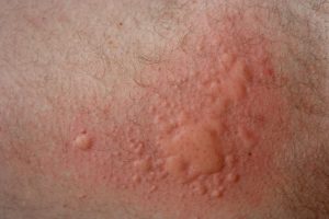 Dermatologists-have-discovered-five-skin-conditions-associated-with-coronavirus