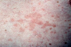 Dermatologists-have-discovered-five-skin-conditions-associated-with-coronavirus