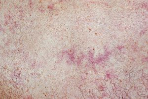 Dermatologists-have-discovered-five-skin-conditions-associated-with-coronavirus