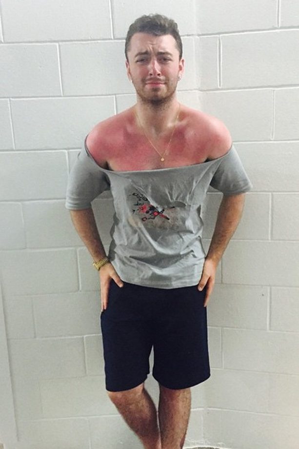 A Very Slim Sam Smith Shows Off His Painful Looking Sunburn, 2015