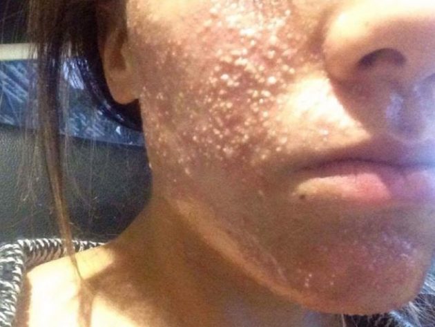 This Beauty Treatment Caused A Horrific Bacterial Skin Infection